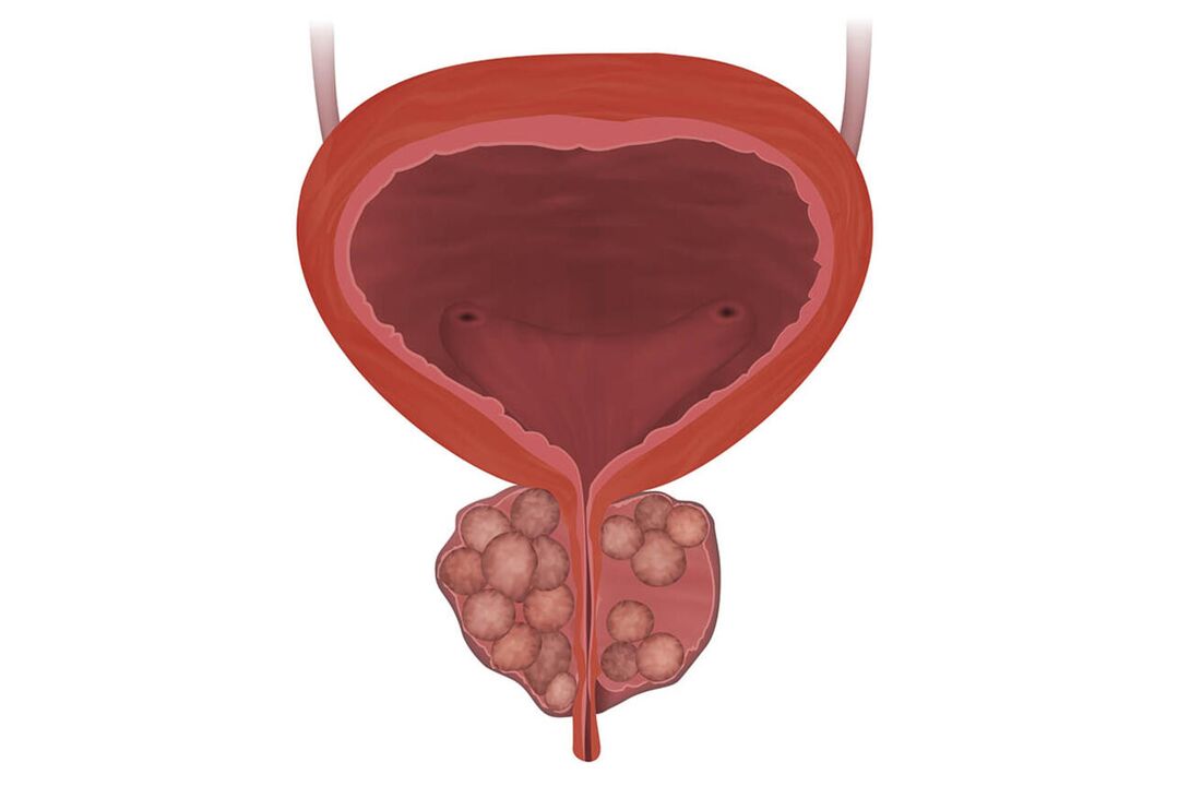 Sintomi della prostatite